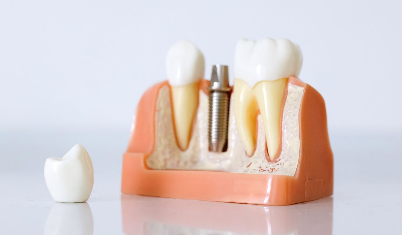 Modello di un'arcata dentale con impianto in titanio e corona, che illustra le soluzioni di implantologia dentale dello Studio Pellitteri