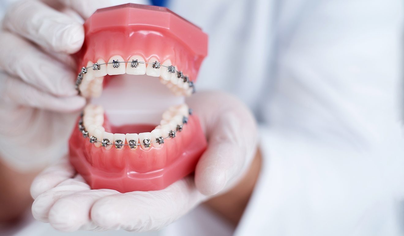 Mani guantate di un dentista mostrano un modello di arcate dentali con apparecchio fisso, simbolo dei trattamenti ortodontici a Bolzano