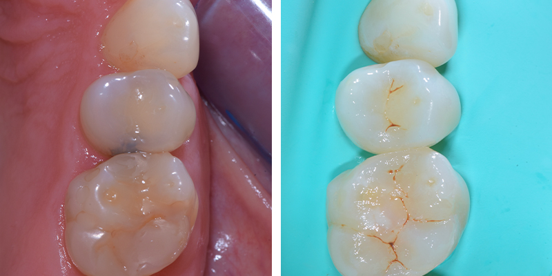 Due immagini affiancate mostrano denti con carie trattate e ricostruzioni estetiche in ceramica.
