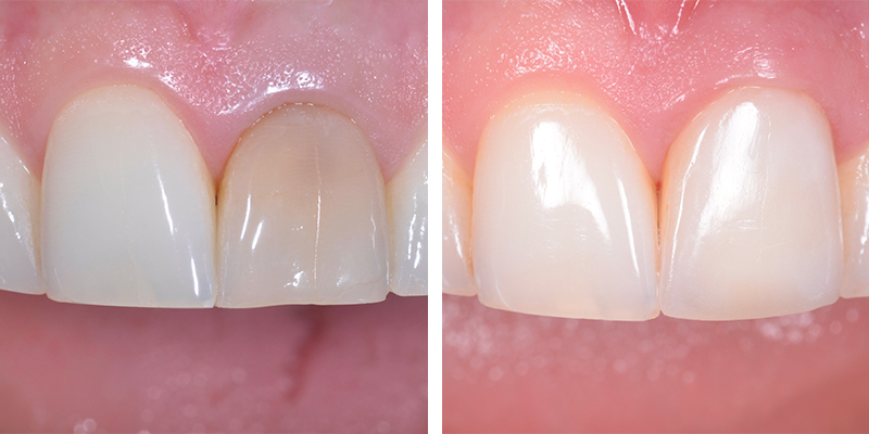 Prima e dopo: Una singola corona su un dente naturale, perfettamente integrata nella mascella del paziente
