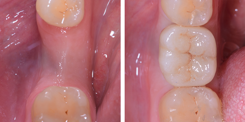 Primo piano di una singola corona dentale su un impianto, perfettamente integrata nella gengiva rosa e sana