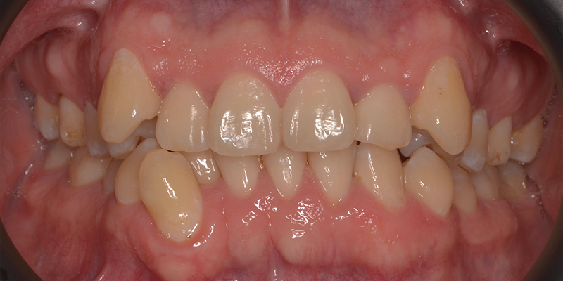Un primo piano della bocca di un paziente mostra un disallineamento dei denti superiori e inferiori, evidenziando la necessità di un trattamento ortodontico