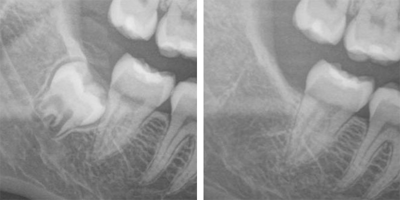 Radiografia dentale che mostra un dente del giudizio incluso prima e dopo l'estrazione chirurgica, evidenziando la precisione dello Studio Pellitteri