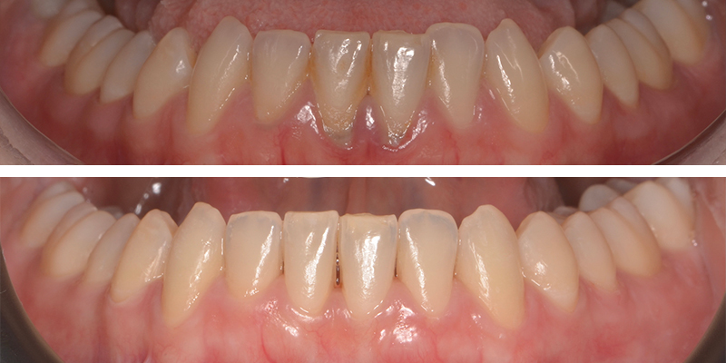 Immagine prima-dopo che mostra il miglioramento dell'igiene dentale: denti più puliti e gengive sane
