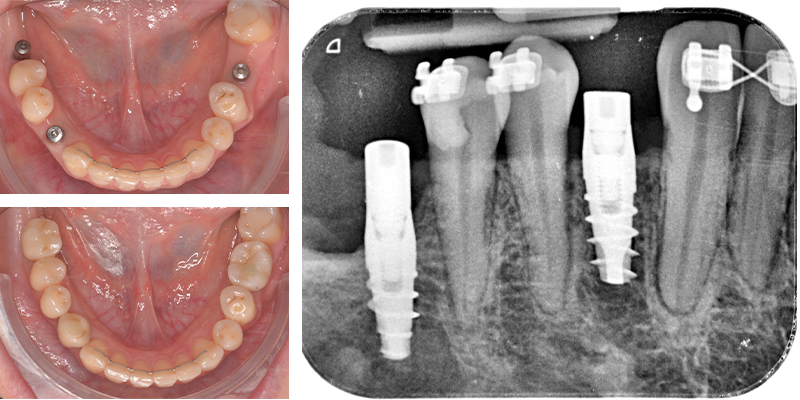 Immagine composita: Due foto intraorali della mandibola con impianti dentali e un'ortopantomografia che mostra gli impianti e l'ortodonzia.