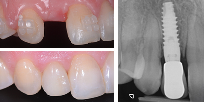 Immagini di un trattamento di implantologia dentale: prima e dopo l'applicazione di un impianto singolo con corona, visibile anche tramite radiografia
