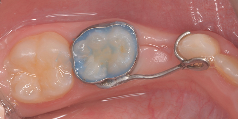 Un mantenitore di spazio ortodontico in metallo su un dente da latte, con un dente permanente adiacente