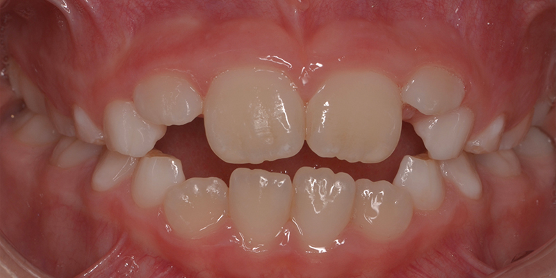 Un primo piano della bocca di un bambino con un morso aperto anteriore, che mostra denti da latte e denti permanenti