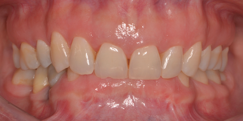 Denti superiori che coprono eccessivamente gli inferiori, indicando un morso profondo che può essere trattato ortodonticamente