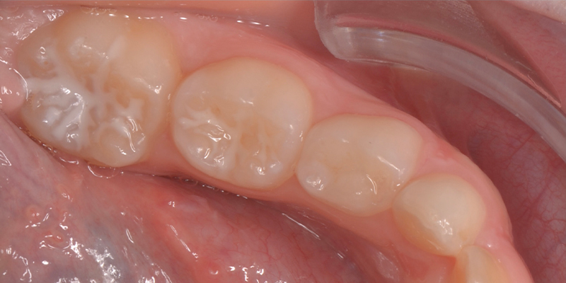 Denti di un bambino con sigillature bianche sulle superfici occlusali per la prevenzione della carie