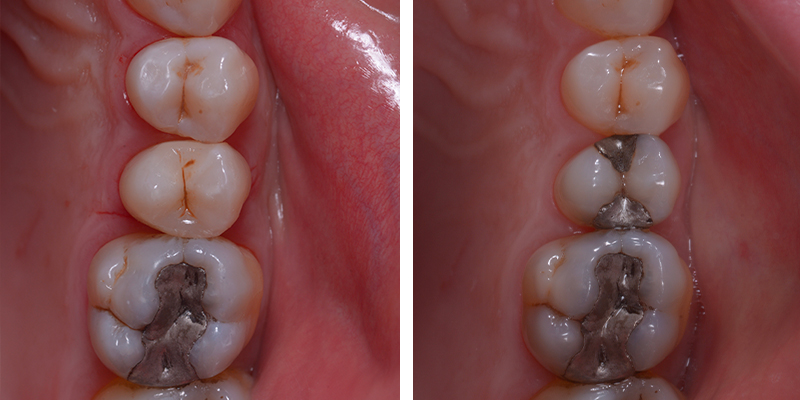 Immagine comparativa prima e dopo la sostituzione delle otturazioni in amalgama con restauri estetici in composito